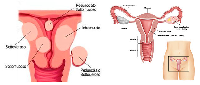 I Fibromi Uterini