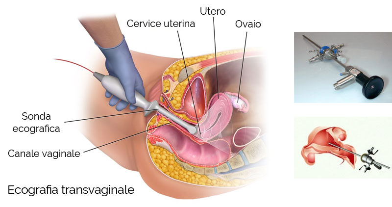 I Fibromi Uterini